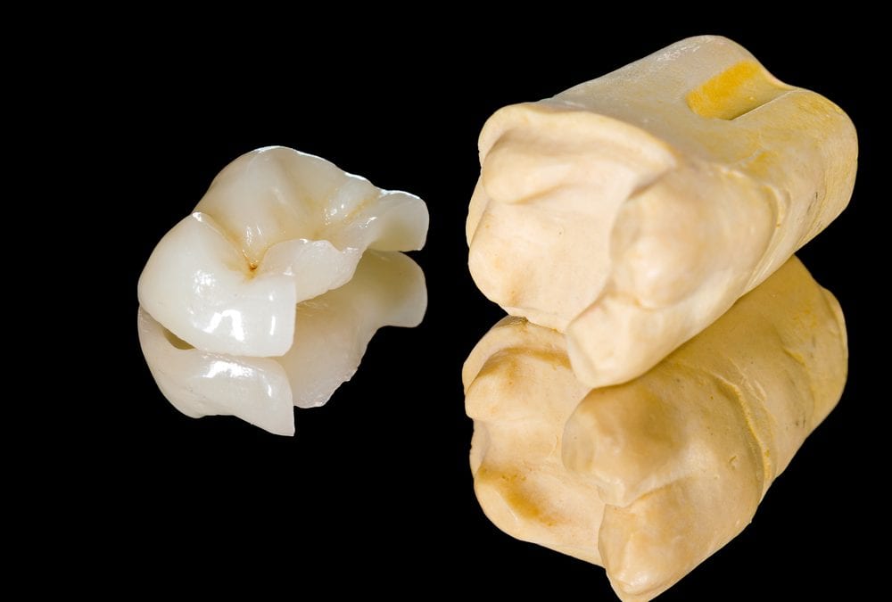 Dental Inlays and Onlays, Laraway Family Dentistry, Family Dentist in the Woodlands TX