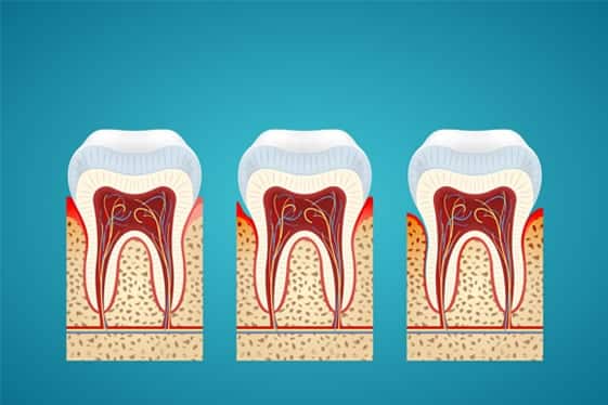Gum Disease, Laraway Family Dentistry, The Woodlands, TX 