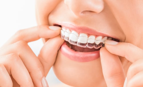 Invisalign in Conroe Texas