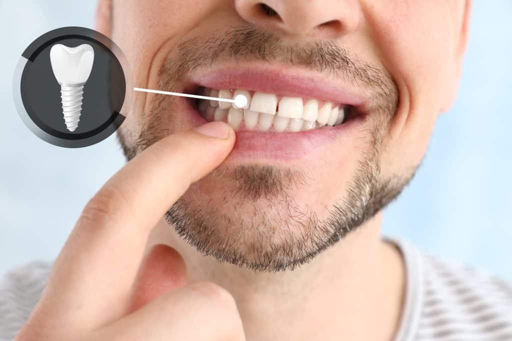 Dental Implants Near Me
